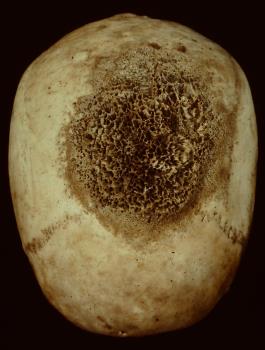 BONE, skull
